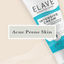 Acne Prone Skin